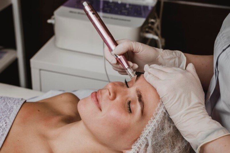 RF microneedling in Singapore