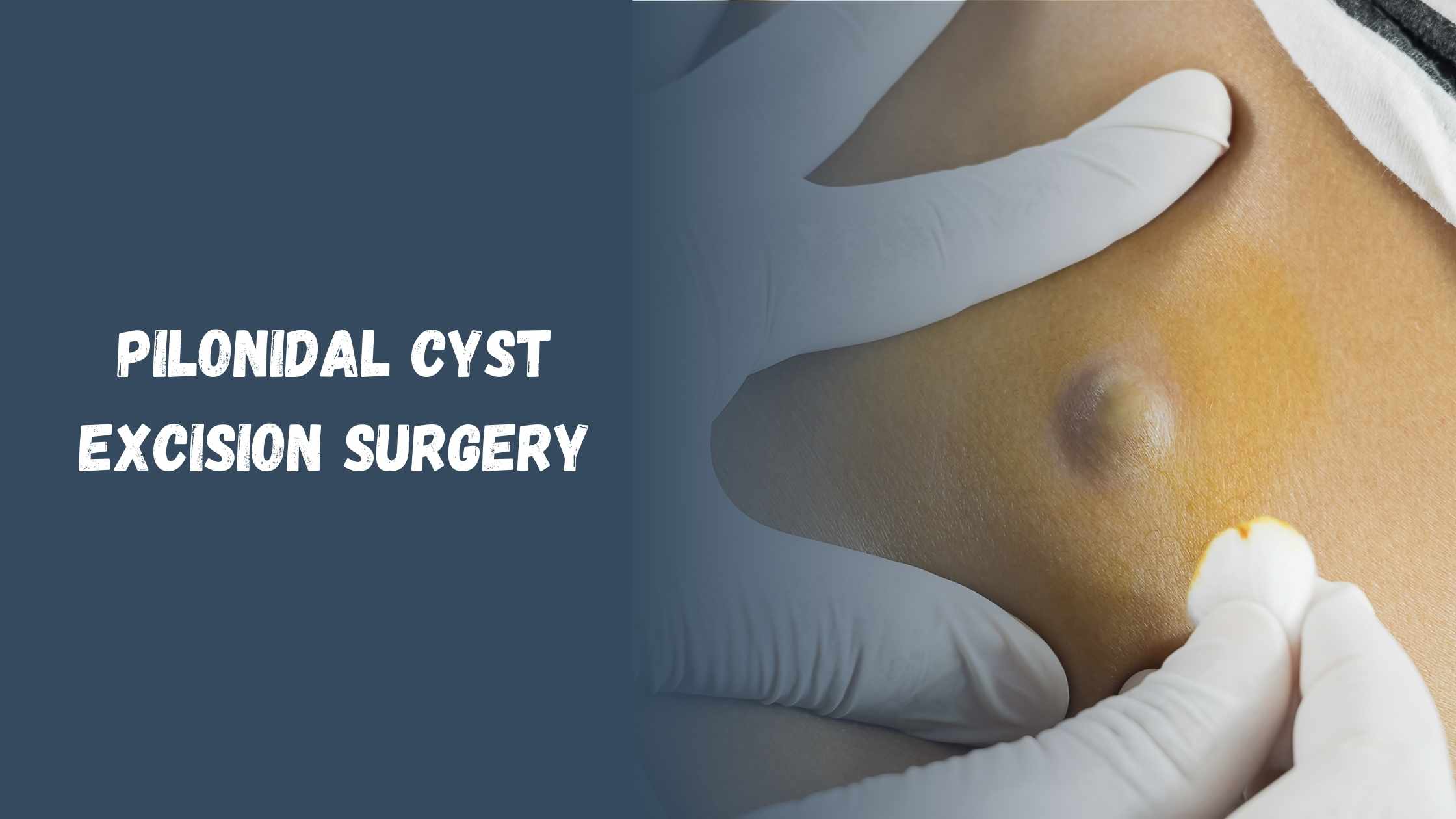 pilonidal cyst excision surgery