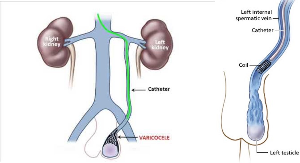 varicocele embolisation