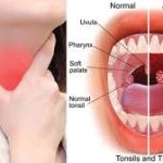 A close-up image of an inflamed throat showing red and swollen tonsils, possibly with white patches, indicating tonsillitis.