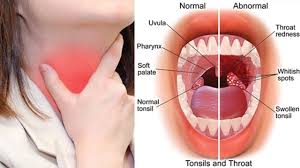 A close-up image of an inflamed throat showing red and swollen tonsils, possibly with white patches, indicating tonsillitis.