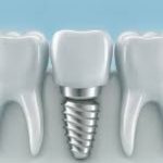 dental implant image