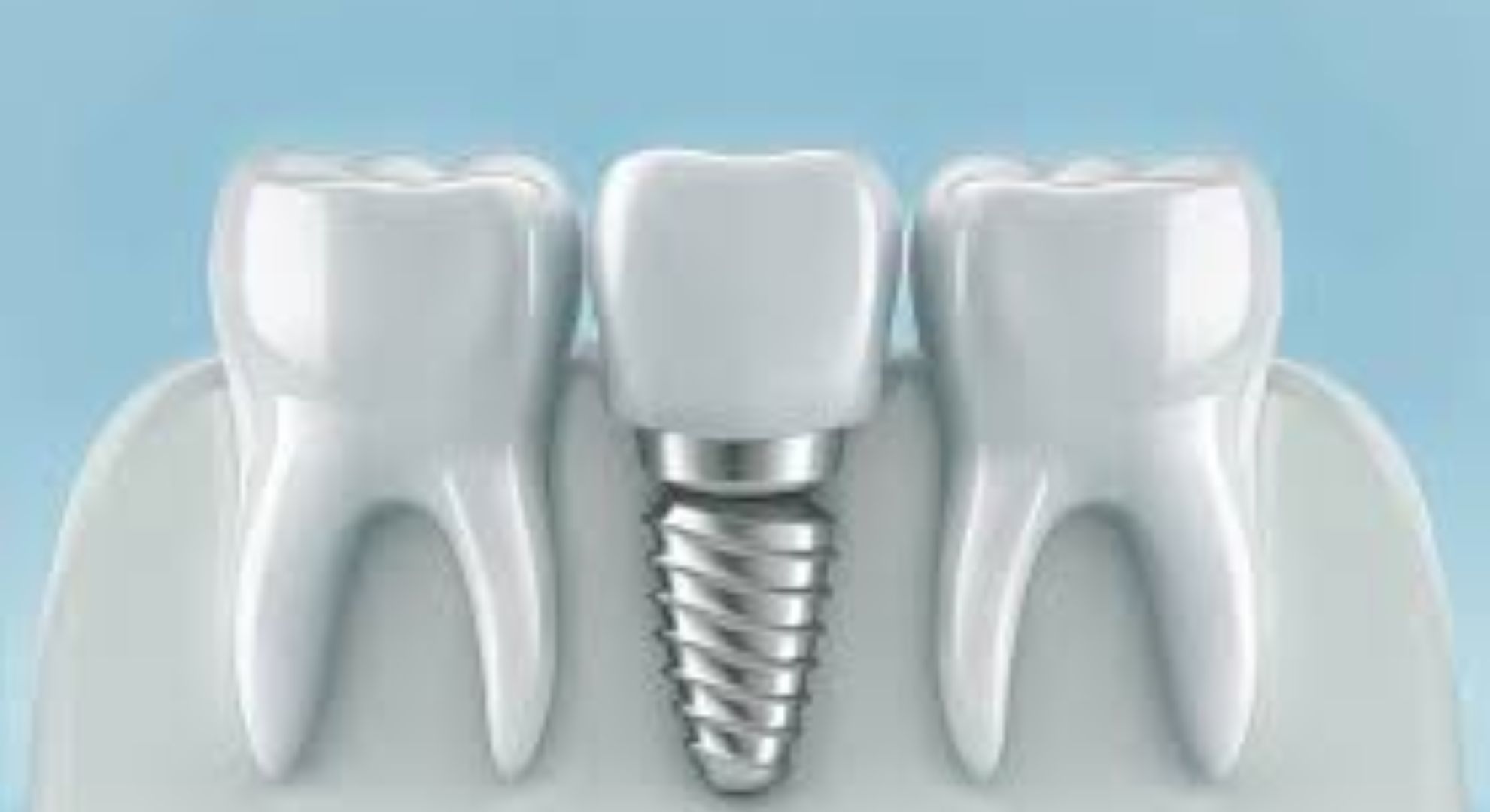 dental implant image