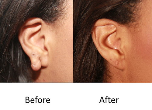 Keloid Removal