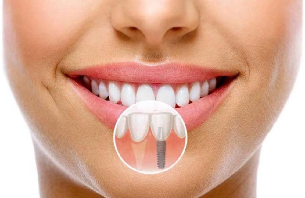 Common Fears About Dental Implants and How to Overcome Them