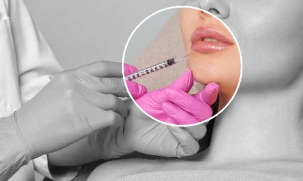 Lip Filler