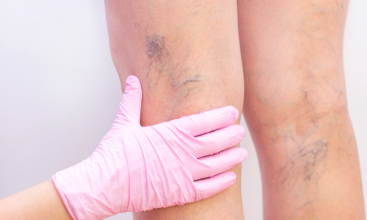 Varicose Veins Treatments